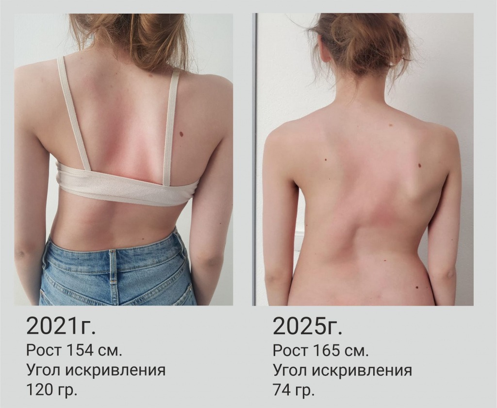 Сколиоз 2.jpg