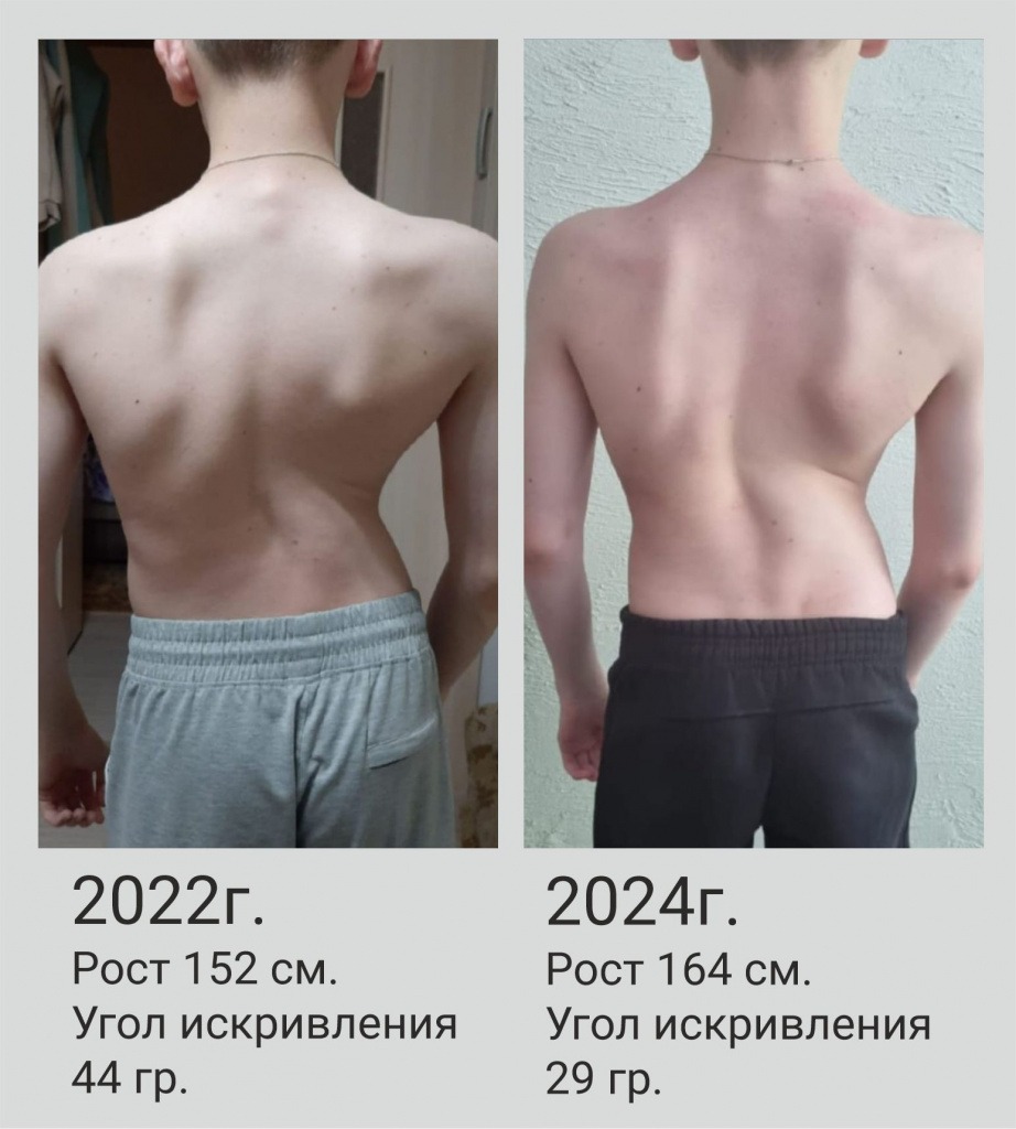 Сколиоз 1.jpg